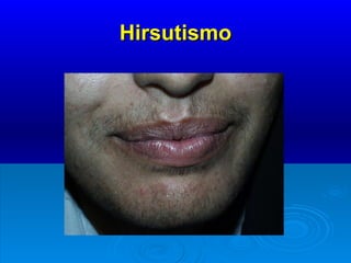 Hirsutismo 