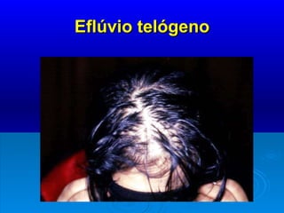 Eflúvio telógeno 