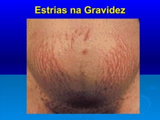 Estrias na Gravidez 