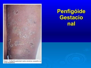 Penfigóide Gestacio nal 