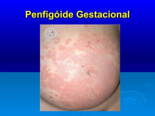 Penfigóide Gestacional 