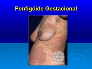 Penfigóide Gestacional 