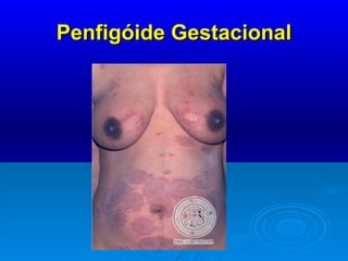 Penfigóide Gestacional 