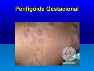 Penfigóide Gestacional 