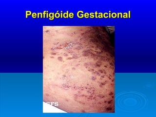 Penfigóide Gestacional 