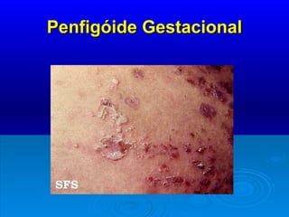 Penfigóide Gestacional 