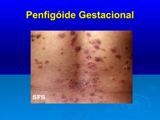 Penfigóide Gestacional 