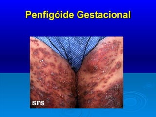 Penfigóide Gestacional 