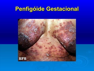 Penfigóide Gestacional 