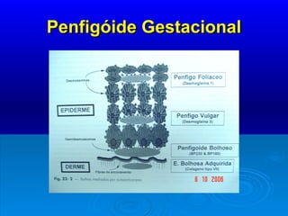 Penfigóide Gestacional 