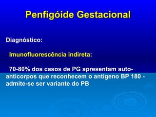 Penfigóide Gestacional Diagnóstico: Imunofluorescência indireta : 70-80% dos casos de PG apresentam auto-  anticorpos que reconhecem o antígeno BP 180 - admite-se ser variante do PB 