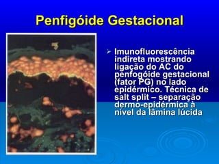Penfigóide Gestacional Imunofluorescência indireta mostrando ligação do AC do penfogóide gestacional (fator PG) no lado epidérmico. Técnica de salt split – separação dermo-epidérmica à nível da lâmina lúcida 