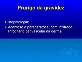 Prurigo da gravidez Histopatologia: Acantose e paraceratose, com infiltrado linfocitário perivascular na derme. 