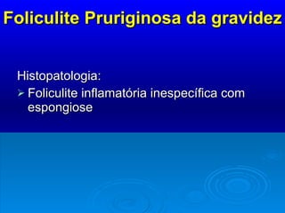 Foliculite Pruriginosa da gravidez Histopatologia:  Foliculite inflamatória inespecífica com espongiose 