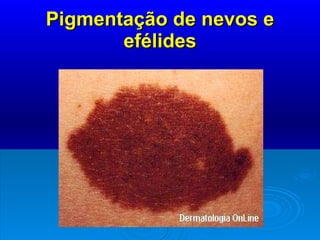 Pigmentação de nevos e efélides 