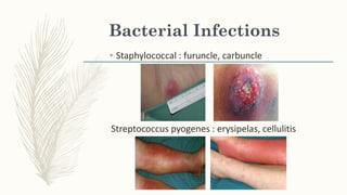 Bacterial Infections
• Staphylococcal : furuncle, carbuncle
Streptococcus pyogenes : erysipelas, cellulitis
 