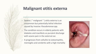 Malignant otitis externa
– Severe ( “ malignant ” ) otitis externa is an
uncommon but potentially lethal infection
caused by invasive Pseudomonas spp.
– The condition occurs in elderly patients with
diabetes and manifests as purulent discharge
with severe pain in the external ear.
– It progresses from cellulitis to osteomyelitis,
meningitis and cerebritis with a high mortality
 