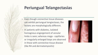 Periungual Telangectasias
– Even though connective tissue diseases
can exhibit periungual tengiectases, the
lesions are morphologically different.
– In patients with diabetes, isolated
homognous engorgement of venular
limbs is seen; whereas mega - capillaries
or irregularly enlarged loops are observed
in those with connective tissue disease
(like RA and dermatomyositis)
 