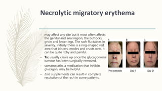 Necrolytic migratory erythema
– may affect any site but it most often affects
the genital and anal region, the buttocks,
groin and lower legs. The rash fluctuates in
severity. Initially there is a ring-shaped red
area that blisters, erodes and crusts over. It
can be quite itchy and painful.
– Tx: usually clears up once the glucagonoma
tumour has been surgically removed.
– somatostatin, a medication that inhibits
glucagon, may be helpful.
– Zinc supplements can result in complete
resolution of the rash in some patients.
 