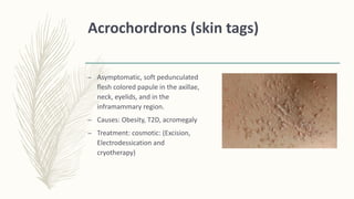 Acrochordrons (skin tags)
– Asymptomatic, soft pedunculated
flesh colored papule in the axillae,
neck, eyelids, and in the
inframammary region.
– Causes: Obesity, T2D, acromegaly
– Treatment: cosmotic: (Excision,
Electrodessication and
cryotherapy)
 