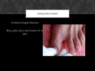 Common fungal infection
Boys, girls, men, and women of all
ages
ATHLETE’S FOOT
 