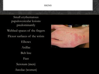Small erythematous
papulovesicular lesions
predominantly
Webbed spaces of the fingers
Flexor surfaces of the wrists
Elbows
Axillae
Belt line
Feet
Scrotum (men)
Areolae (women)
SIGNS
 