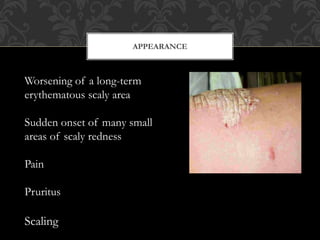 APPEARANCE
Worsening of a long-term
erythematous scaly area
Sudden onset of many small
areas of scaly redness
Pain
Pruritus
Scaling
 
