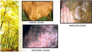 LINEAR LESION
                    ANNULAR LESION




  ARCIFORM LESION
 