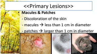 <<Primary Lesions>>
• Macules & Patches
  - Discoloration of the skin
  - macules  less than 1 cm in diameter
  - patches  larger than 1 cm in diameter
 