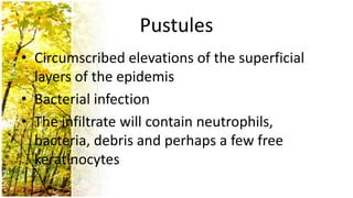 Pustules
• Circumscribed elevations of the superficial
  layers of the epidemis
• Bacterial infection
• The infiltrate will contain neutrophils,
  bacteria, debris and perhaps a few free
  keratinocytes
 