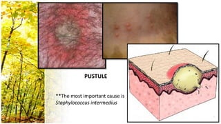 PUSTULE


**The most important cause is
Staphylococcus intermedius
 