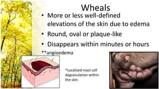 Wheals
• More or less well-defined
  elevations of the skin due to edema
• Round, oval or plaque-like
• Disappears within minutes or hours
**angioedema


        *Localised mast cell
        degranulation within
        the skin
 