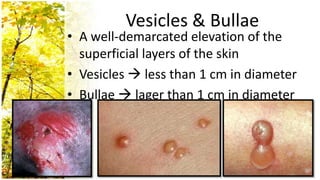 Vesicles & Bullae
• A well-demarcated elevation of the
  superficial layers of the skin
• Vesicles  less than 1 cm in diameter
• Bullae  lager than 1 cm in diameter
 