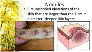 Nodules
• Circumscribed elevations of the
  skin that are larger than the 1 cm in
  diameter deeper skin layers
 