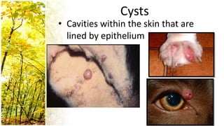 Cysts
• Cavities within the skin that are
  lined by epithelium
 