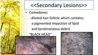 <<Secondary Lesions>>
• Comedones
  - dilated hair follicle which contains
    a pigmented impaction of lipid
    and keratinaceous debris
  “BLACK HEAD”
 