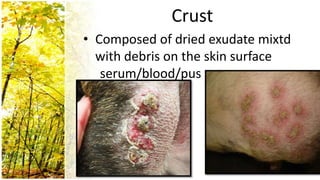 Crust
• Composed of dried exudate mixtd
  with debris on the skin surface
   serum/blood/pus
 