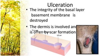 Ulceration
• The integrity of the basal layer
   basement membrane is
  destroyed
• The dermis is involved and healing
  is often by scar formation
 