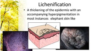 Lichenification
• A thickening of the epidermis with an
  accompanying hyperpigmentation in
  most instances elephant skin like
 