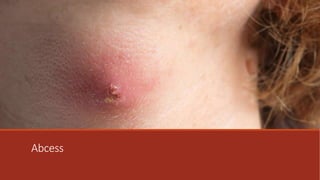 dermatological infections.pptx