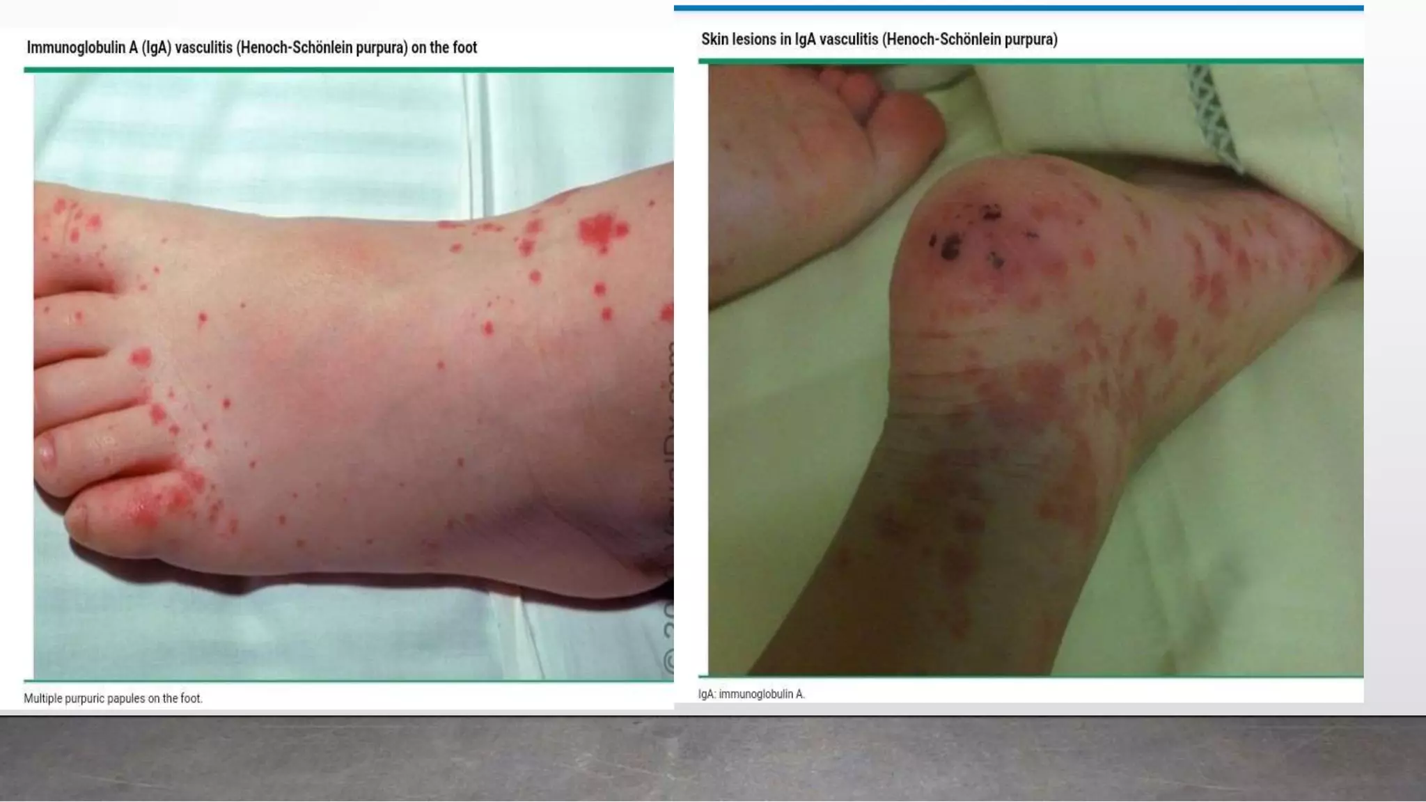 Renal Rashes Dermatologic manifestations of renal diseases | PPTX