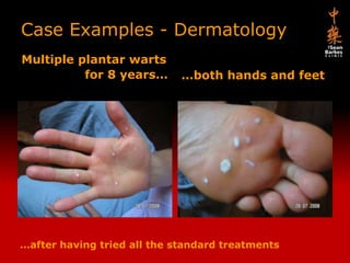 Case Examples - Dermatology Multiple plantar warts …both hands and feet for 8 years… …after having tried all the standard treatments 