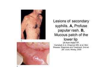 Lesions of secondary
syphilis. A, Profuse
papular rash. B,
Mucous patch of the
lower lip
(A from Habif TP,
Campbell JI Jr, Chapman MS, et al. Skin
Disease: Diagnosis and Treatment, 2nd ed.
St. Louis, Mosby, 2005.(
 