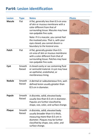 Part4: Lesion identification
Lesion Type Notes Photo
Macule Flat A flat, generally less than 0.5-cm area
of skin or mucous membrane with a
color different from that of
surrounding tissue. Macules may have
non-palpable fine scale.
Note: If it is macular, you cannot feel
the involved area. That is, with your
eyes closed, you cannot discern a
boundary to the lesional area.
Patch Flat A flat, generally greater than 0.5-
cm area of skin or mucous membrane
with a color different from that of
surrounding tissue. Patches may have
non-palpable fine scale.
Cyst Smooth
Raised
A closed cavity or sac containing fluid
or semisolid material. A cyst may have
an epithelial, endothelial, or
membranous lining.
Nodule Smooth
Raised
A dermal or subcutaneous firm, well-
defined lesion usually greater than
0.5 cm in diameter.
Papule Smooth
Raised
A discrete, solid, elevated body
usually less than 0.5 cm in diameter.
Papules are further classified by
shape, size, color, and surface change.
Plaque Smooth
Raised
A discrete, solid, elevated body
usually broader than it is thick,
measuring more than 0.5 cm in
diameter. Plaques may be further
classified by shape, size, color, and
surface change.
 