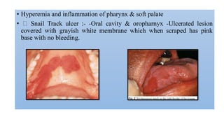 • Hyperemia and inflammation of pharynx & soft palate
• Snail Track ulcer :- -Oral cavity & oropharnyx -Ulcerated lesion
covered with grayish white membrane which when scraped has pink
base with no bleeding.
 