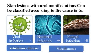 Skin lesions with oral manifestations Can
be classified according to the cause in to:
Viral
infection
Bacterial
infection
Fungal
infection
Autoimmune diseases Miscellaneous
 