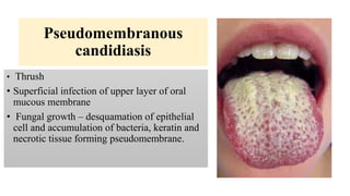 Pseudomembranous
candidiasis
• Thrush
• Superficial infection of upper layer of oral
mucous membrane
• Fungal growth – desquamation of epithelial
cell and accumulation of bacteria, keratin and
necrotic tissue forming pseudomembrane.
 