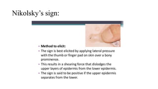 Nikolsky’s sign:
 