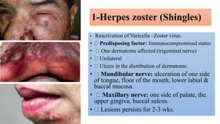 1-Herpes zoster (Shingles)
• Reactivation of Varicella –Zoster virus.
• Predisposing factor: Immunocompromised status
• One dermatome affected (trigeminal nerve)
• Unilateral
• Ulcers in the distribution of dermatome.
• Mandibular nerve: ulceration of one side
of tongue, floor of the mouth, lower labial &
buccal mucosa.
• Maxillary nerve: one side of palate, the
upper gingiva, buccal sulcus.
• Lesions persists for 2-3 wks.
 