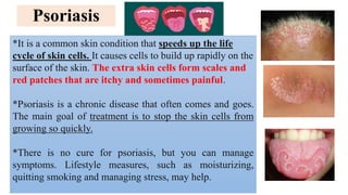 Psoriasis
*It is a common skin condition that speeds up the life
cycle of skin cells. It causes cells to build up rapidly on the
surface of the skin. The extra skin cells form scales and
red patches that are itchy and sometimes painful.
*Psoriasis is a chronic disease that often comes and goes.
The main goal of treatment is to stop the skin cells from
growing so quickly.
*There is no cure for psoriasis, but you can manage
symptoms. Lifestyle measures, such as moisturizing,
quitting smoking and managing stress, may help.
 